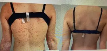 Fabbrocini (Federico II): \"Biologici migliorano pelle pazienti psoriasi\"