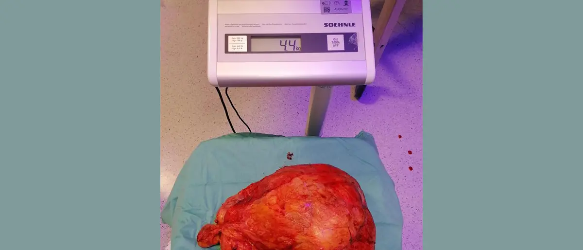 Ospedale di Cosenza, intervento da record: asportato un tumore di 4 chili e mezzo