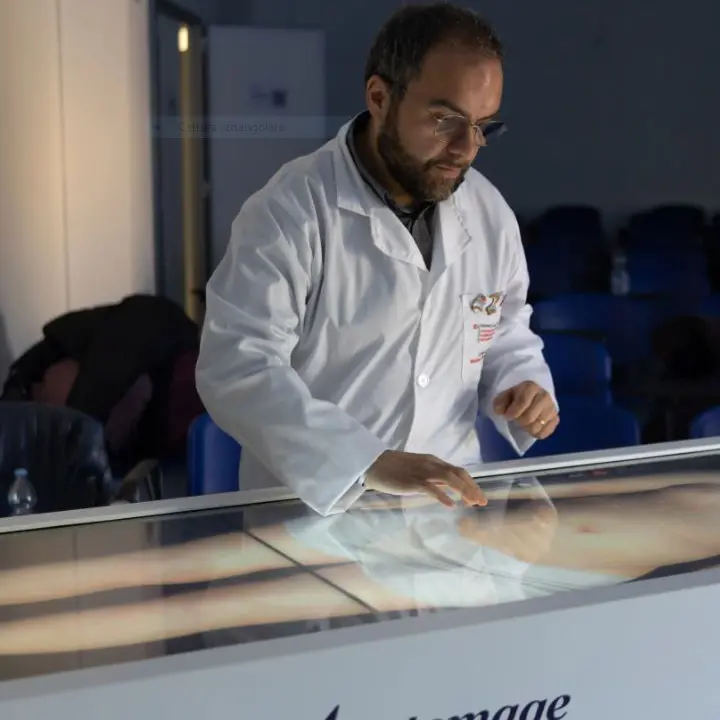 Cosenza, tumore di 10 kg asportato con il supporto del tavolo anatomico 3D dell'Unical
