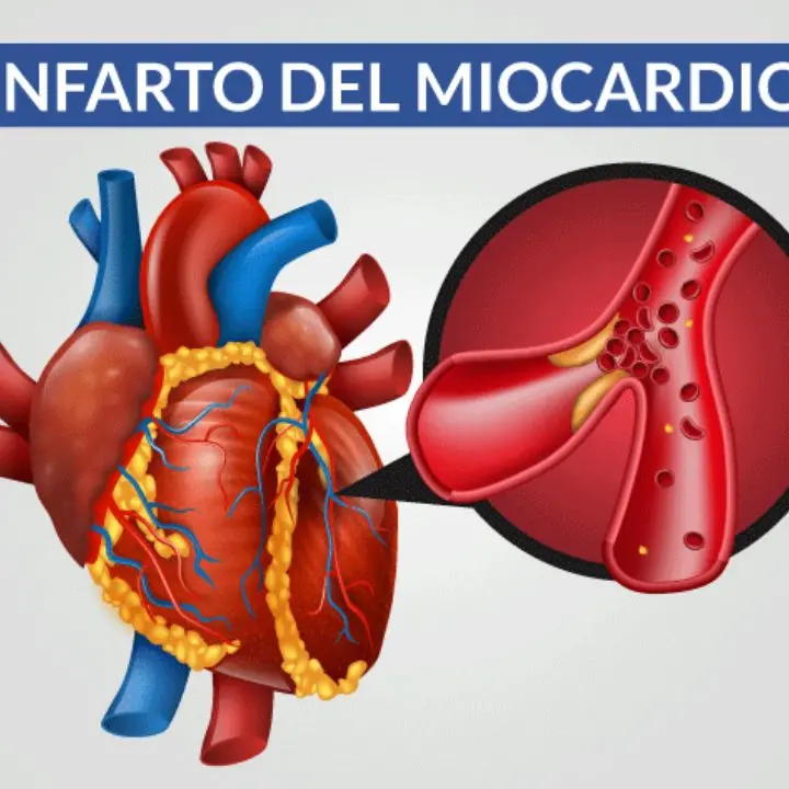 Infarto miocardico, la principale causa è l'aterosclerosi: prevenzione e vita sana fanno la differenza