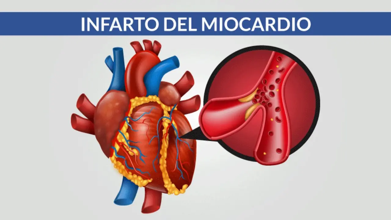 Infarto miocardico, la principale causa è l'aterosclerosi: prevenzione e vita sana fanno la differenza