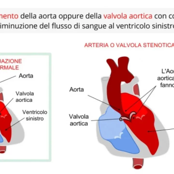 Stenosi aortica, il rilascio della valvola biologica mediante catetere soppianta l'intervento classico