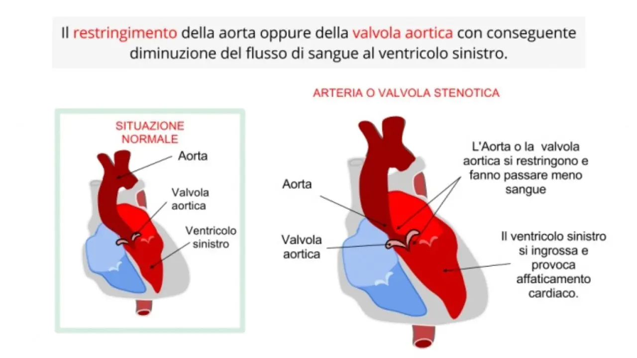 Stenosi aortica, il rilascio della valvola biologica mediante catetere soppianta l'intervento classico