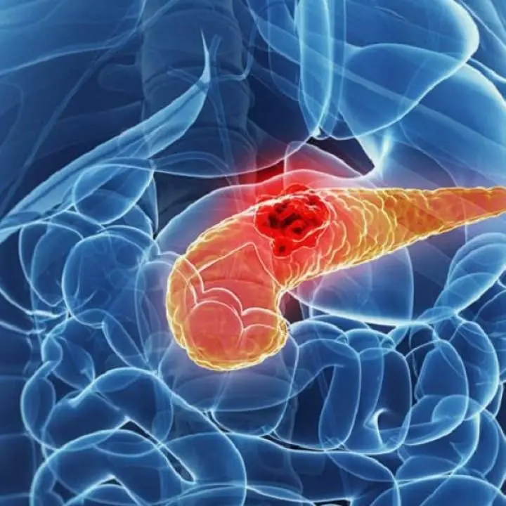 Tumore al pancreas, studio italiano svela il meccanismo della malattia