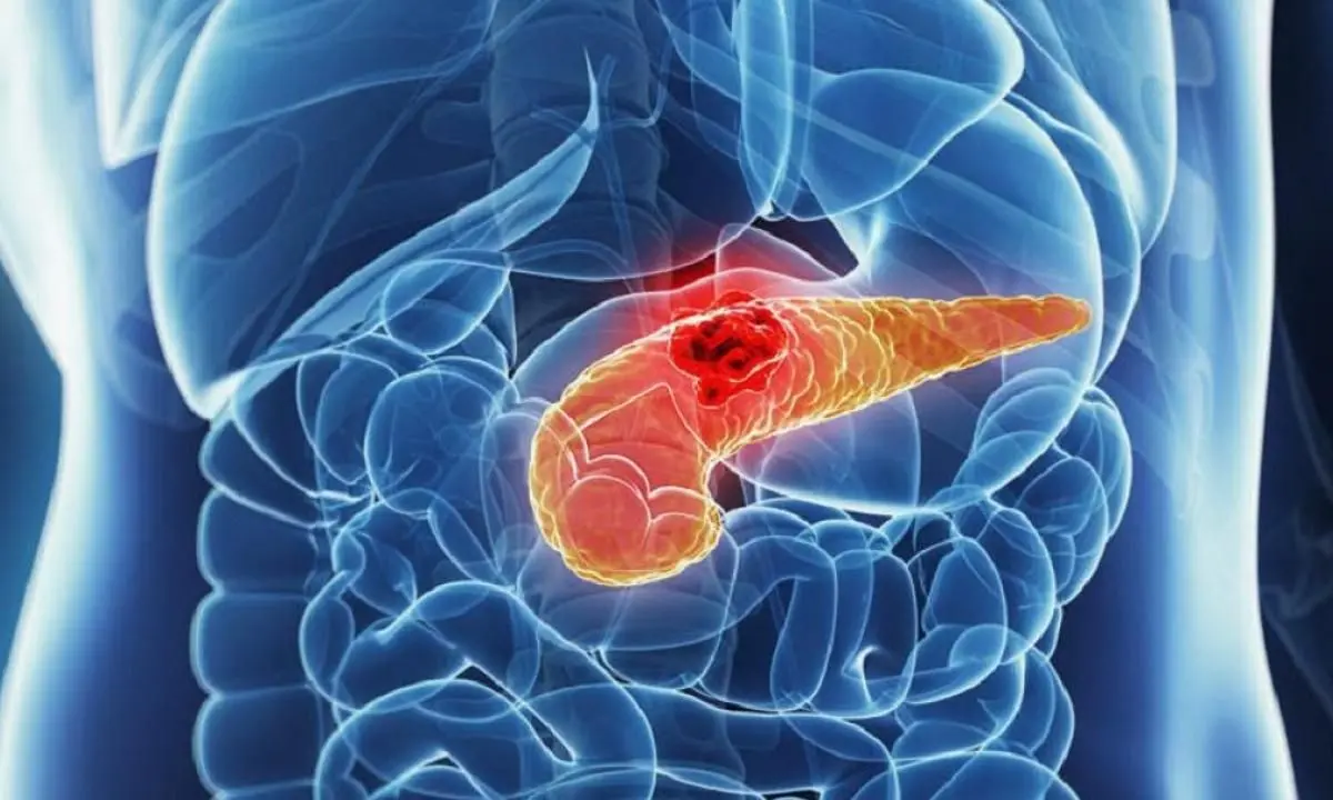 Tumore al pancreas, studio italiano svela il meccanismo della malattia