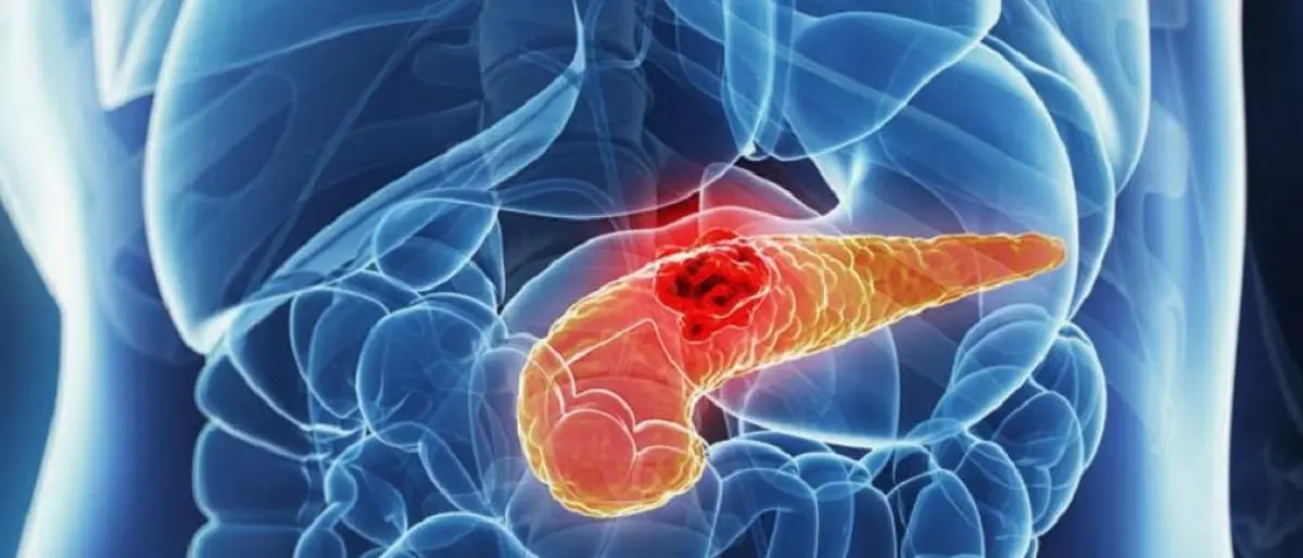 Tumore al pancreas, studio italiano svela il meccanismo della malattia