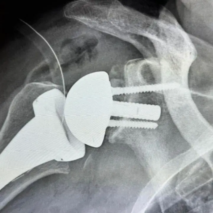 Belvedere Marittimo, primo intervento di protesi di spalla con la realtà aumentata