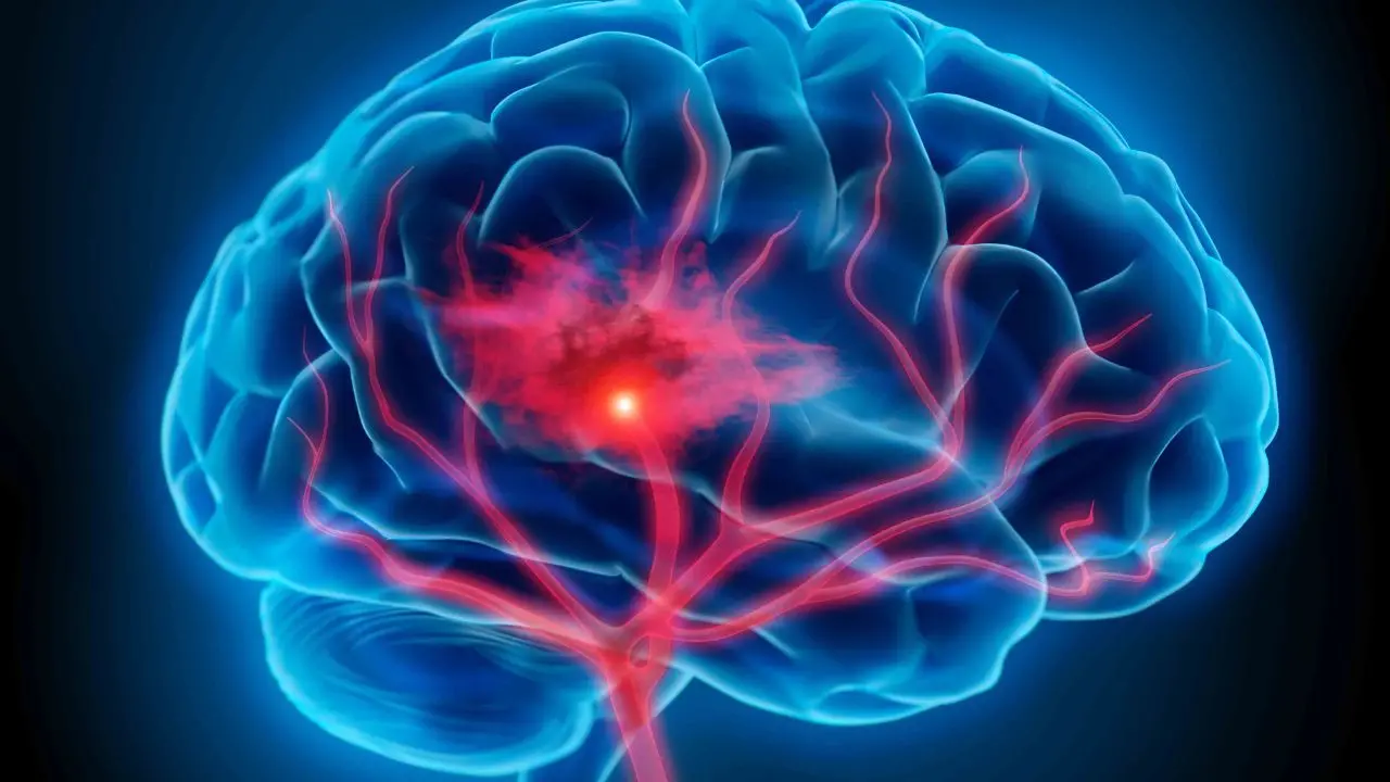 Intelligenza artificiale e ictus cerebrale: progetto innovativo alla Dulbecco di Catanzaro