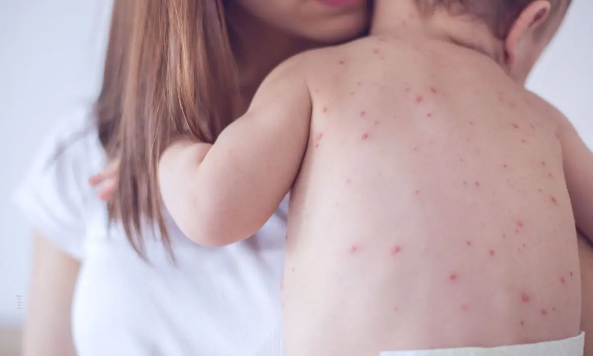 Morbillo, boom di casi in Europa: nel 2024 oltre 127mila contagi, raddoppiati rispetto all’anno precedente