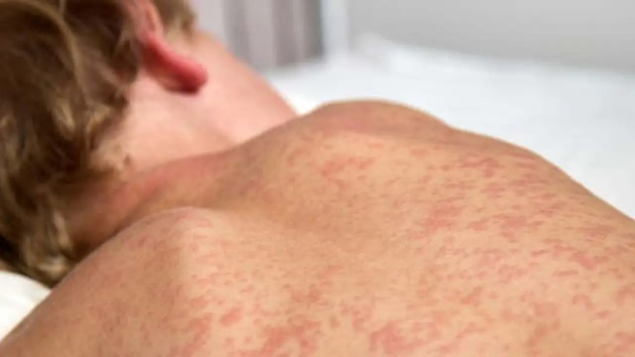 Morbillo, in Italia 213 casi nei primi tre mesi del 2024