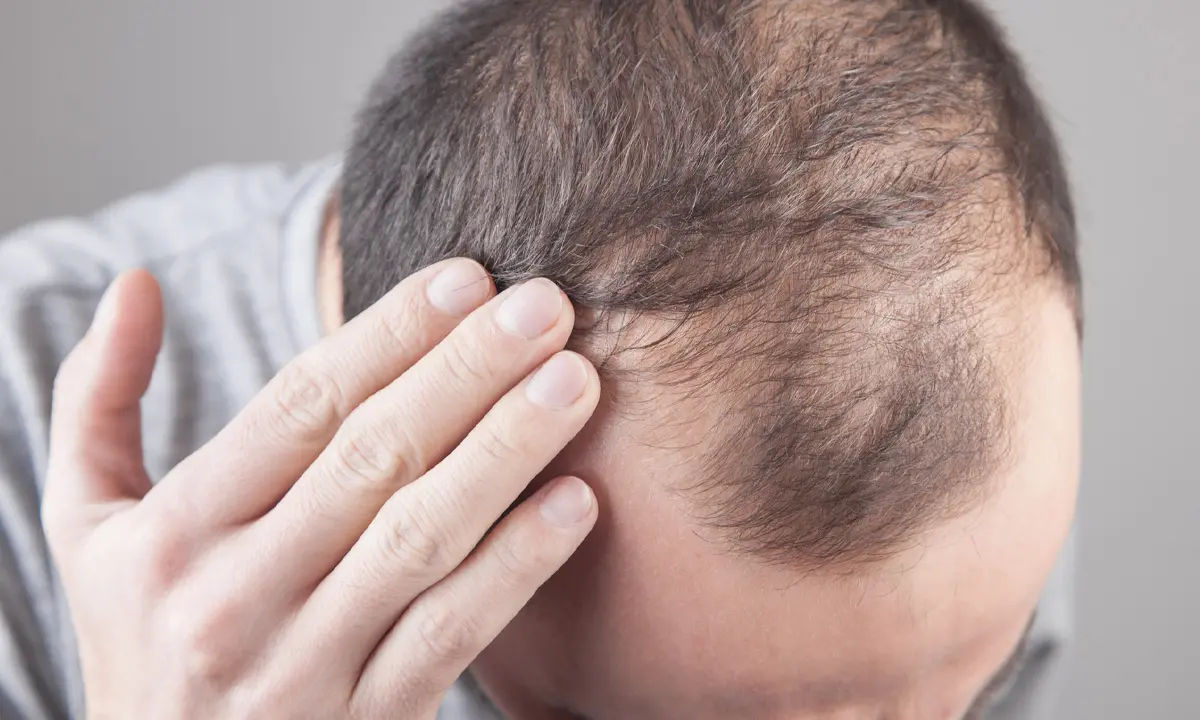 Cos'è la nuova pillola che promette di combattere l’alopecia areata grave