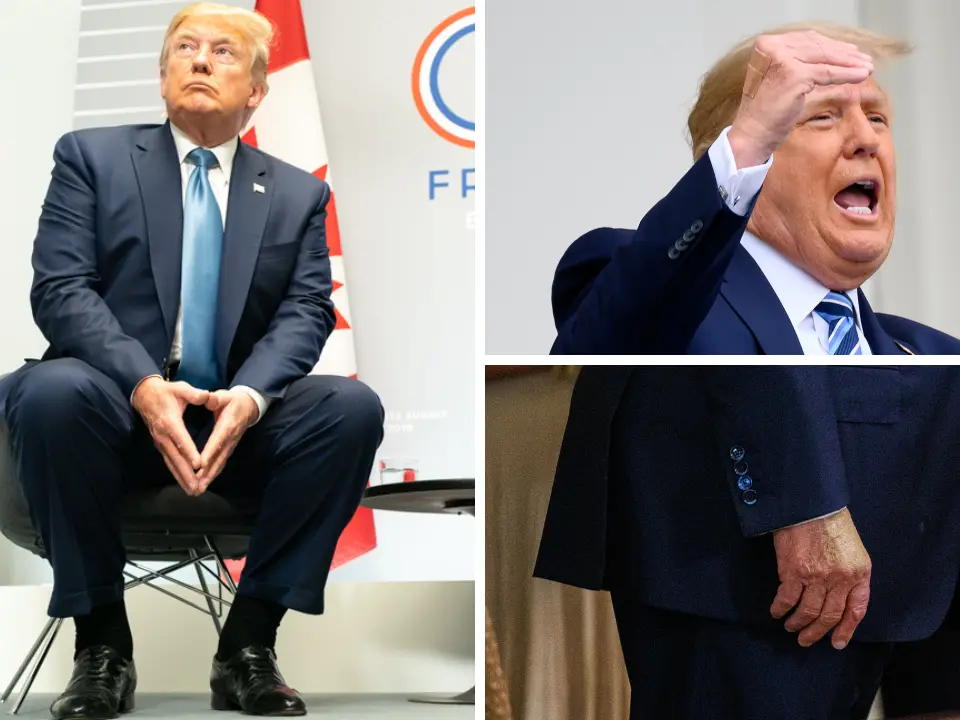 Caviglie gonfie e lividi sulle mani, il web s’interroga sulla salute di Trump e la Casa Bianca rassicura: «Nessun mistero»