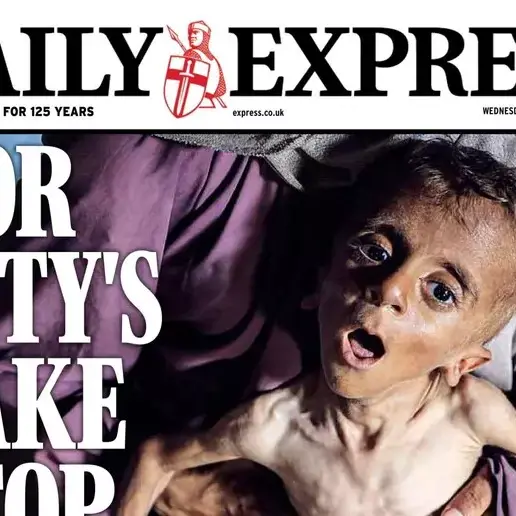 Il bimbo di Gaza come uno scheletro: l’immagine di Muhammad sciocca il mondo\n