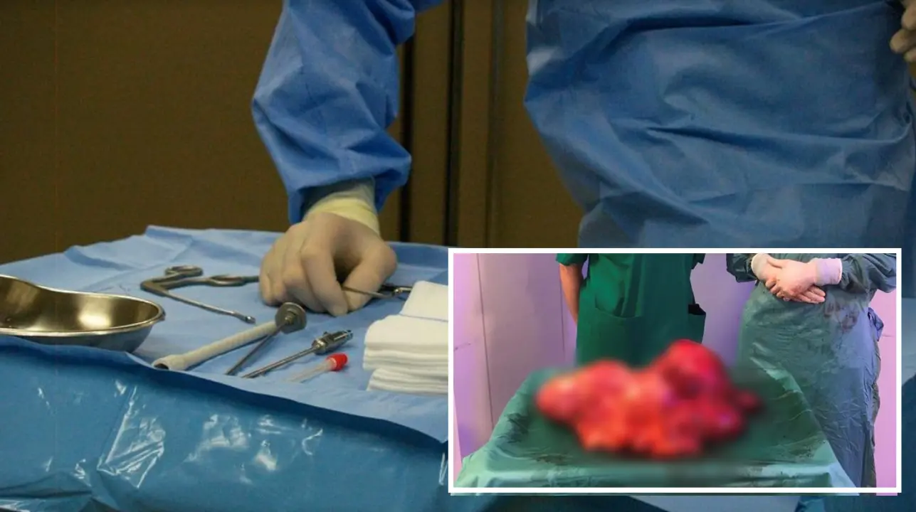 Intervento record a Cosenza, l'equipe del vibonese Bruno Nardo asporta tumore di 7,5 Kg