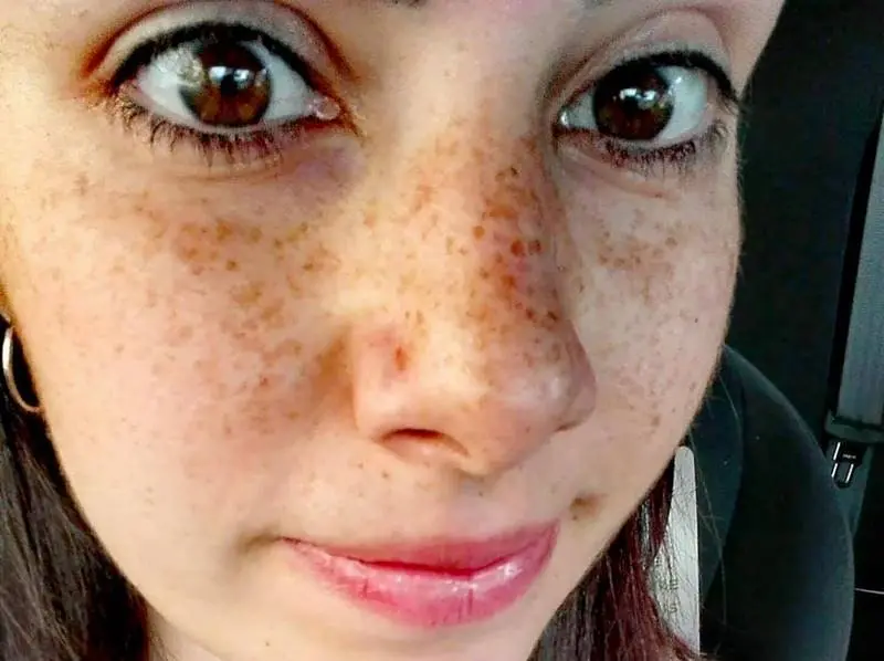 La battaglia per la vita di Vanessa Gasparro: «Non arrendetevi mai»