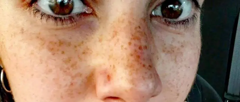 La battaglia per la vita di Vanessa Gasparro: «Non arrendetevi mai»