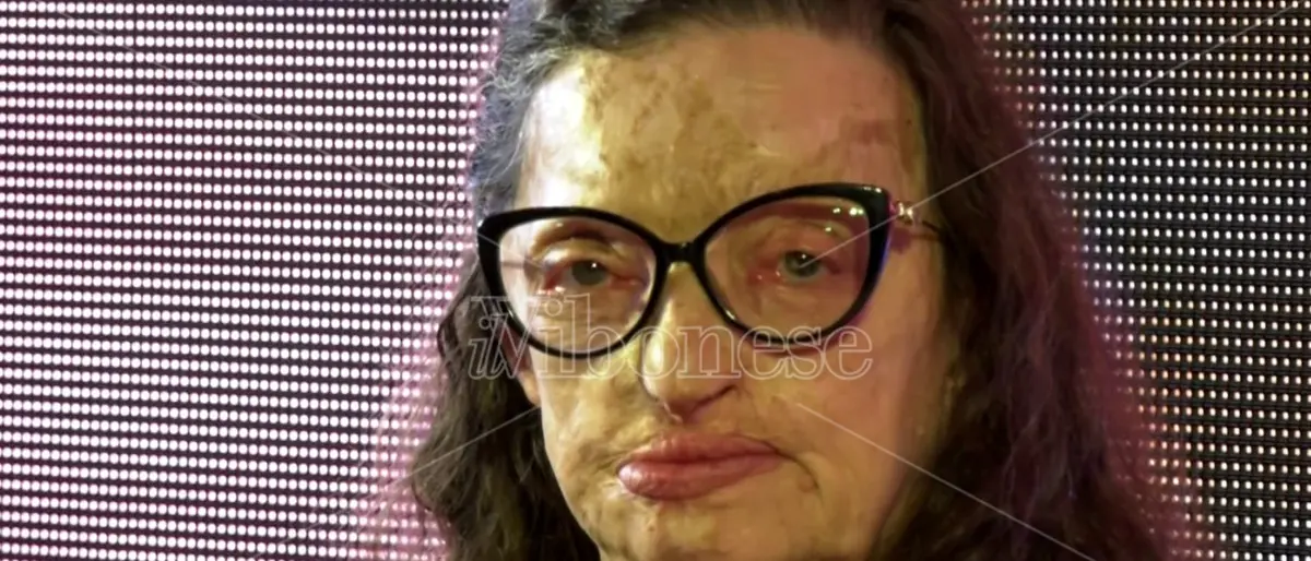 Sfigurata dall'ex racconta il suo dramma: a Vibo la testimonianza di Filomena Lamberti - Video