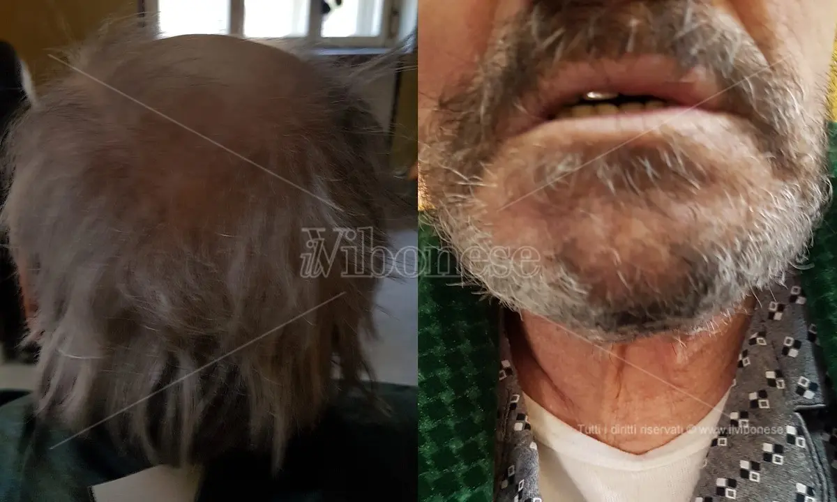 La denuncia: «Mio padre ridotto come un barbone dopo un mese di ricovero allo Jazzolino»