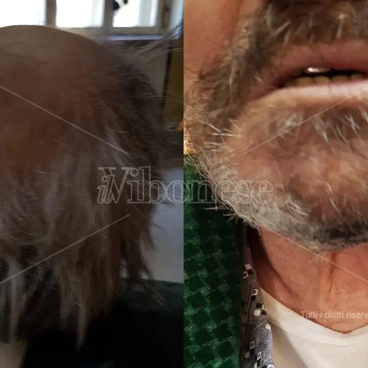 La denuncia: «Mio padre ridotto come un barbone dopo un mese di ricovero allo Jazzolino»