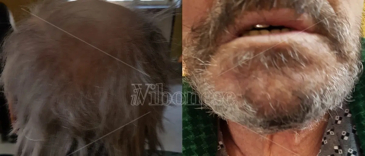 La denuncia: «Mio padre ridotto come un barbone dopo un mese di ricovero allo Jazzolino»