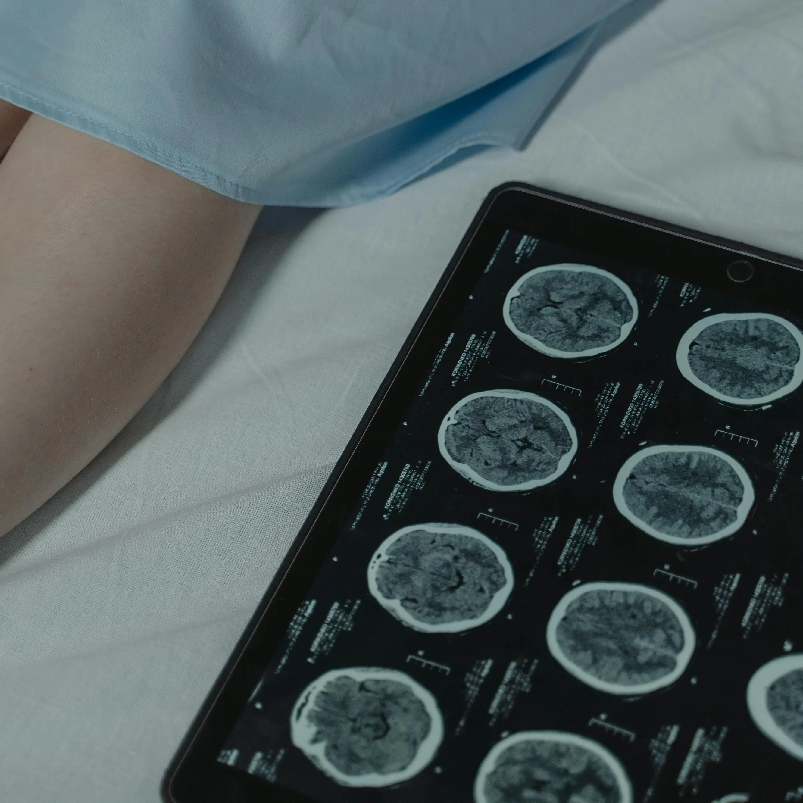 Alla Dulbecco di Catanzaro un nuovo polo multicentrico per la diagnosi e la cura delle malattie neurologiche\n
