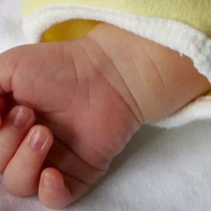 Cosenza, è morto\u00A0il bambino vibonese di 4 mesi trasferito d’urgenza nella Terapia intensiva neonatale dell’Annunziata