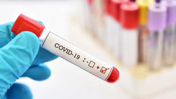 Blood sample tube positive with COVID-19 or novel coronavirus 2019 found in Wuhan, China , Getty Images/iStockphoto