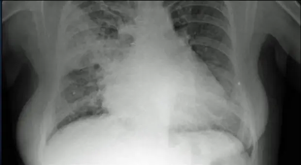 Il Covid e la polmonite bilaterale. Ecco come il virus uccide