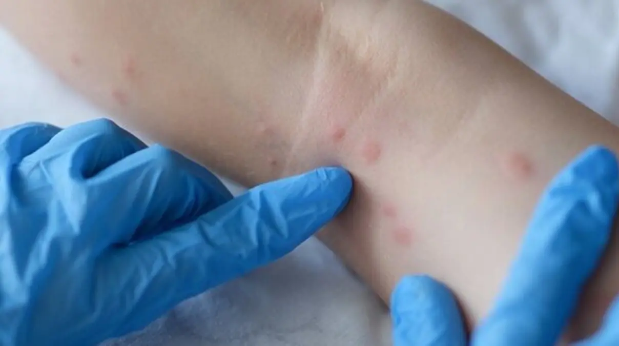 Vaiolo delle scimmie, ecco cosa c’è da sapere