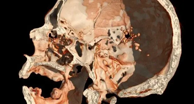 Tecnico radiologo del GOM di Reggio pubblica studio su un caso di traumatismo cranico penetrante da arma da fuoco