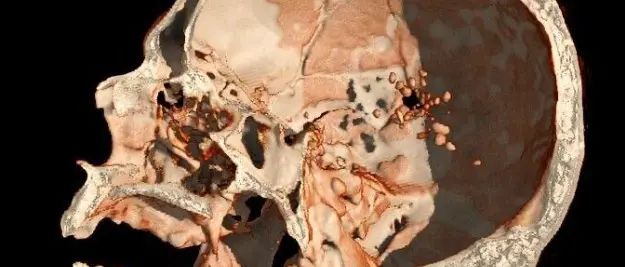 Tecnico radiologo del GOM di Reggio pubblica studio su un caso di traumatismo cranico penetrante da arma da fuoco