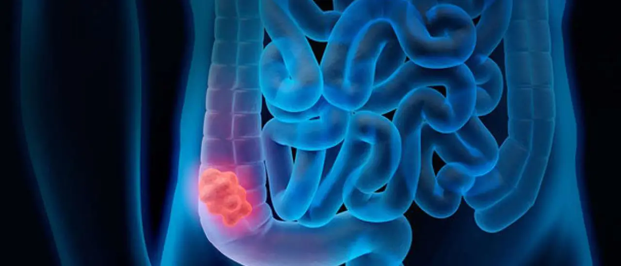 Tumore al colon-retto, la speranza per la cura arriva da Reggio Calabria