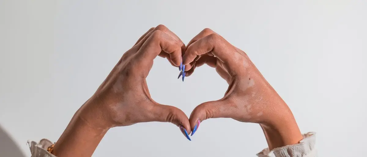 In Calabria arriva la Vitiligine Week, una settimana di consulenze mediche gratuite anche per adolescenti