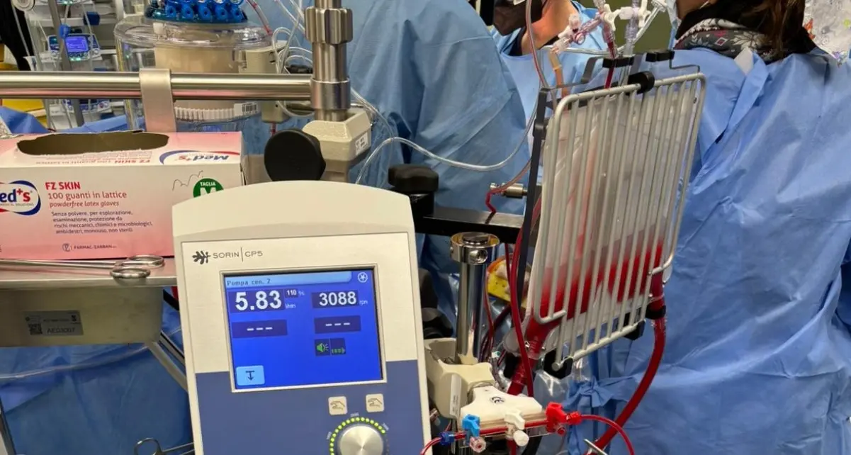 La Cardiochirurgia Dulbecco di Catanzaro adotta\u00A0il programma “mini-circolazione extracorporea”: è l’unico del sud Italia\n