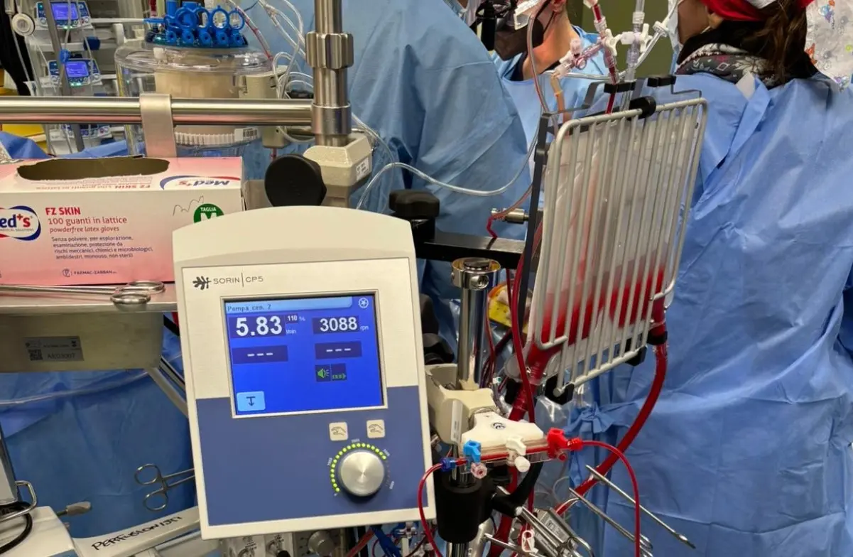La Cardiochirurgia Dulbecco di Catanzaro adotta\u00A0il programma “mini-circolazione extracorporea”: è l’unico del sud Italia\n