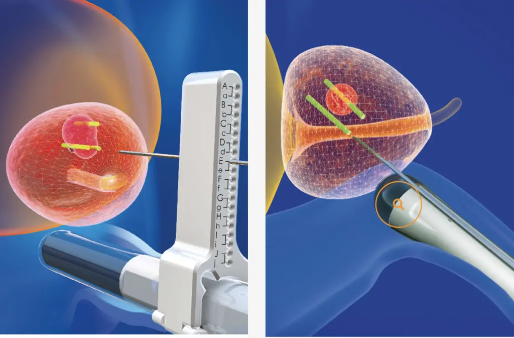 Tumore alla prostata, «cosentini costretti a pagare 1.500 euro per una biopsia con tecnica fusion»\n