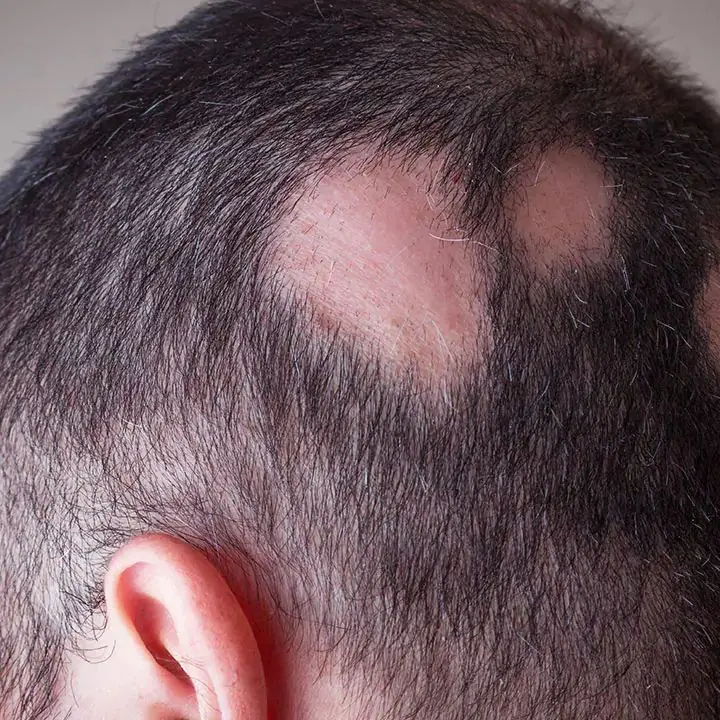 Alopecia areata, una malattia invisibile: Cosenza accende i riflettori\n
