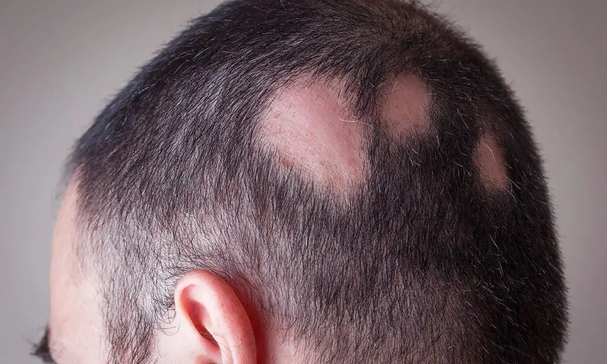 Alopecia areata, una malattia invisibile: Cosenza accende i riflettori\n