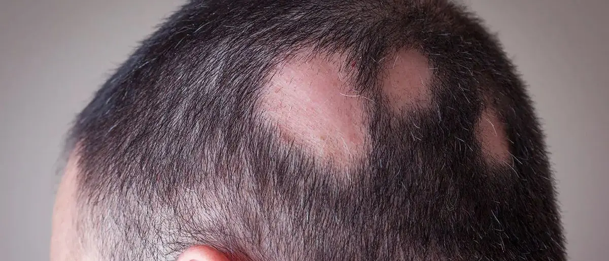 Alopecia areata, una malattia invisibile: Cosenza accende i riflettori\n