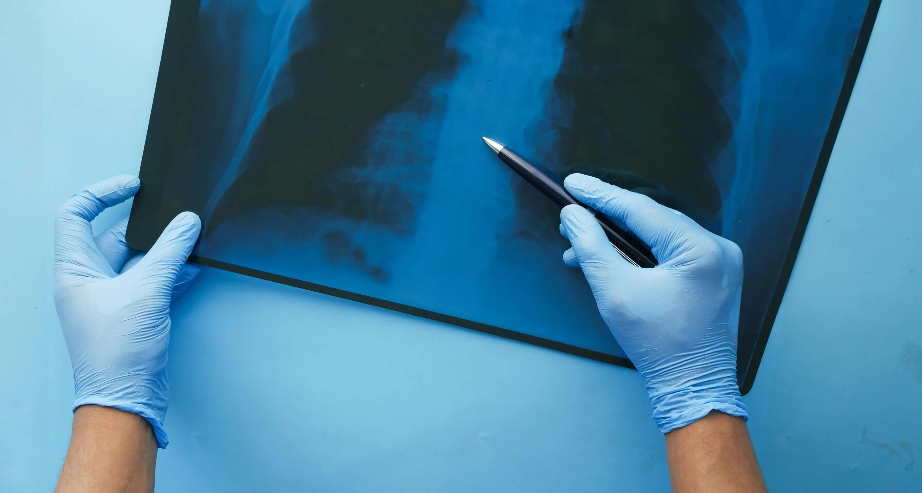 Influenza aggressiva, aumentano polmoniti e accessi al pronto soccorso: ospedale di Catanzaro sotto pressione (ma niente emergenza)