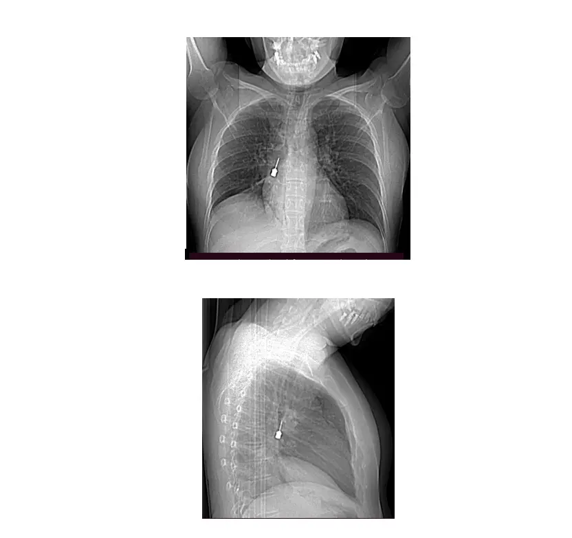 Giovane donna inala accidentalmente cacciavite\u00A0odontoiatrico:\u00A0intervento d’emergenza al Gom di Reggio\n