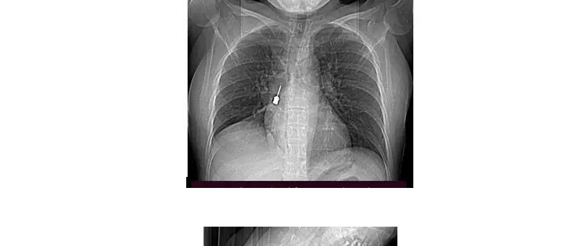 Giovane donna inala accidentalmente cacciavite\u00A0odontoiatrico:\u00A0intervento d’emergenza al Gom di Reggio\n