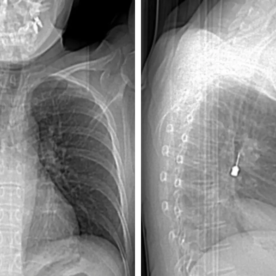 Al Gom di Reggio delicato intervento d’urgenza per rimuovere un cacciavite odontoiatrico incastrato in un bronco\n
