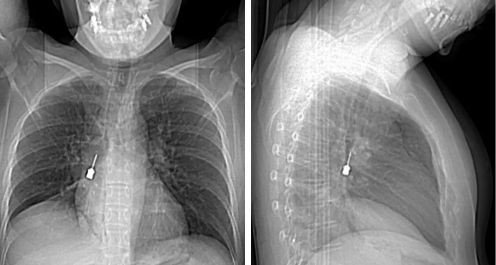 Al Gom di Reggio delicato intervento d’urgenza per rimuovere un cacciavite odontoiatrico incastrato in un bronco\n
