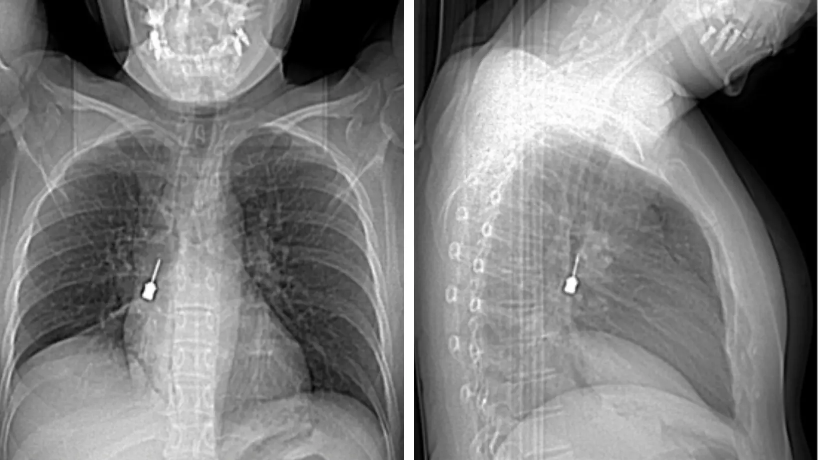 Al Gom di Reggio delicato intervento d’urgenza per rimuovere un cacciavite odontoiatrico incastrato in un bronco\n