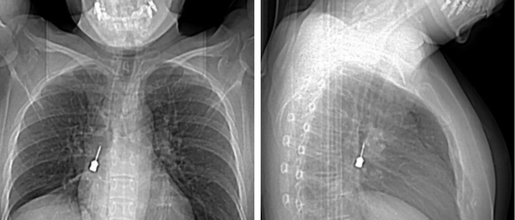 Al Gom di Reggio delicato intervento d’urgenza per rimuovere un cacciavite odontoiatrico incastrato in un bronco\n