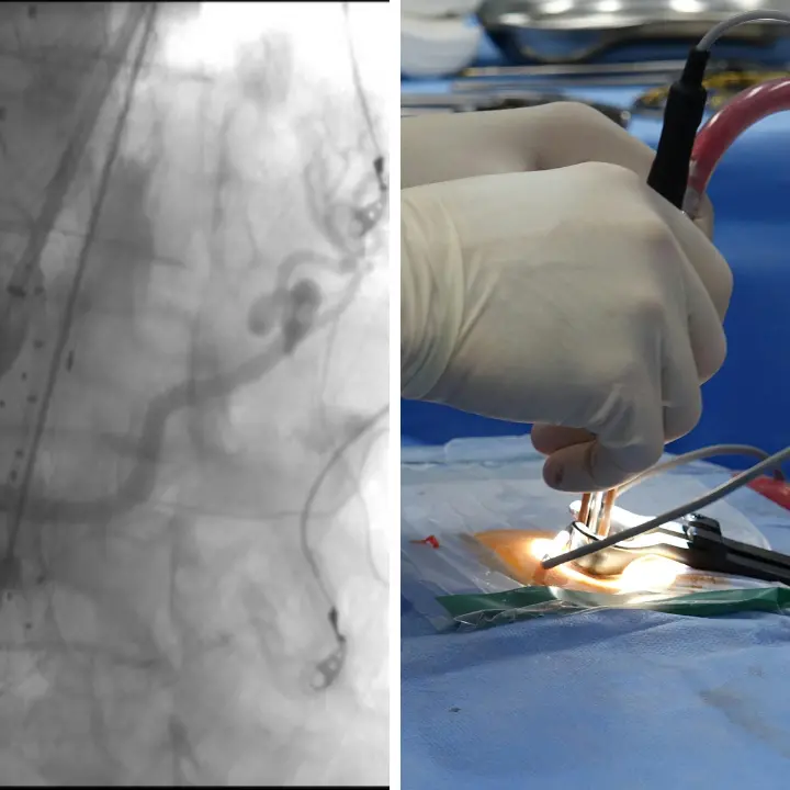 Al Gom di Reggio eseguito con successo un complesso intervento su un aneurisma dell’aorta toraco-addominale\n