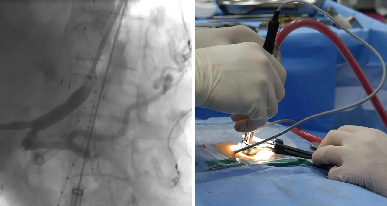 Al Gom di Reggio eseguito con successo un complesso intervento su un aneurisma dell’aorta toraco-addominale\n