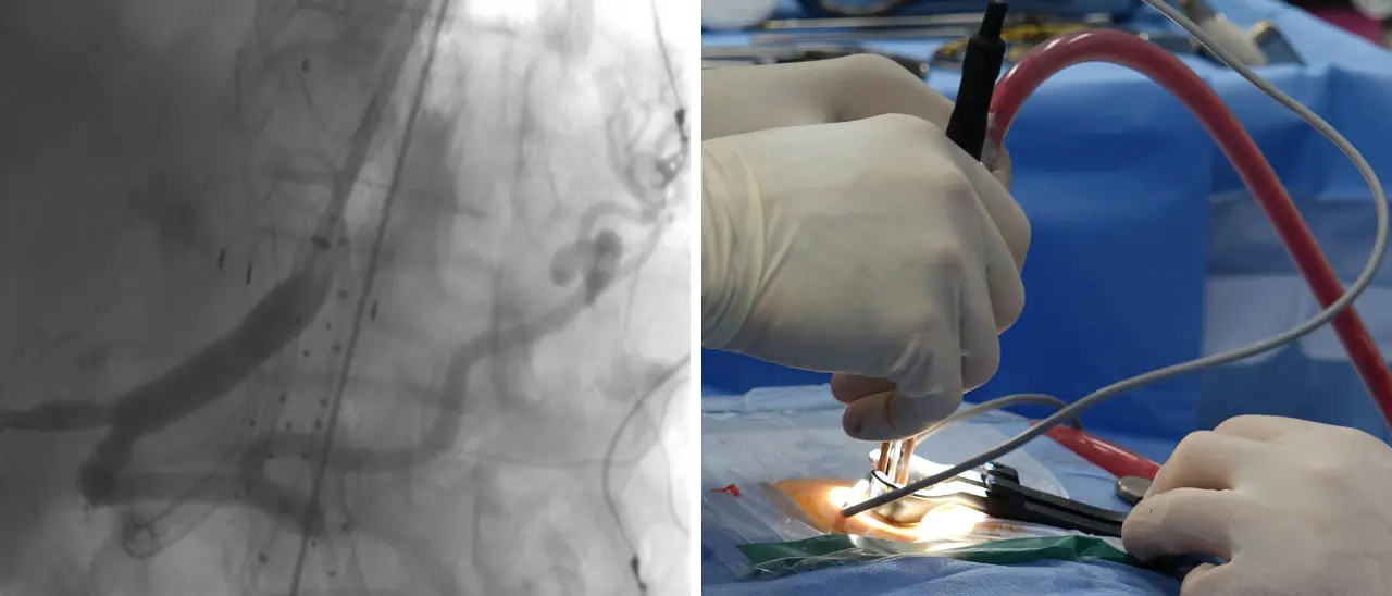 Al Gom di Reggio eseguito con successo un complesso intervento su un aneurisma dell’aorta toraco-addominale\n