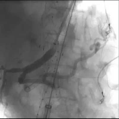 Aneurisma dell’aorta toraco-addominale, eseguito trattamento di elevata complessità dalla U.O.C. Chirurgia Vascolare del G.O.M.\n